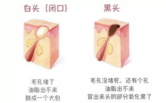 辨別黑頭與閉口，黑頭儀的正確使用與誤區(qū)